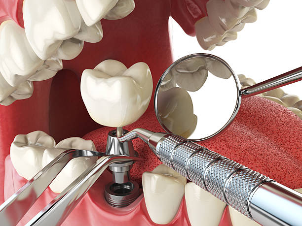 Best Emergency Wisdom Teeth Removal in Merian, ID